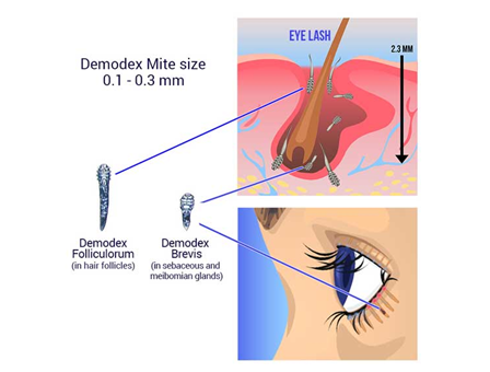 Τα ακάρεα Demodex προκαλούν φλεγμονή στα βλέφαρα και ξηροφθαλμία