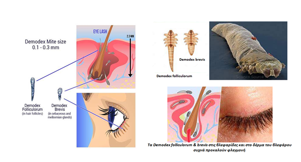 Τα Demodex brevis & folliculorum ζουν στους θύλακες των βλεφαρίδων και στο δέρμα