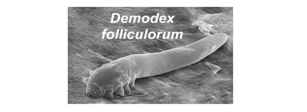 Η υπερανάπτυξη παρασίτων Demodex στα βλέφαρα και τις βλεφαρίδες έχει ως επίπτωση την εμφάνιση χρόνιων συμπτωμάτων βλεφαρίτιδας, ξηροφθαλμίας, μαδάρωσης, χαλαζιου, εκζέματος