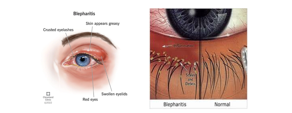 Η δεμοδήκωση, τα παράσιτα Demodex και η φλεγμονή που έχουν προκαλέσει αντιμετωπίζονται με την καθημερινή υγιεινή των βλεφάρων/βλεφαρίδων με Ophthalmogen