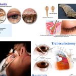 Βλεφαρίτιδα και Γλαύκωμα